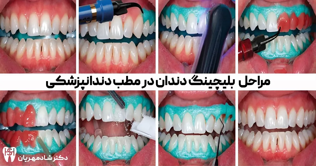 مراحل انجام بلیچینگ دندان در مطب دندان پزشکی-بلیچینگ آفیس