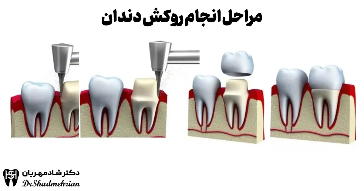 مراحل انجام روکش دندان