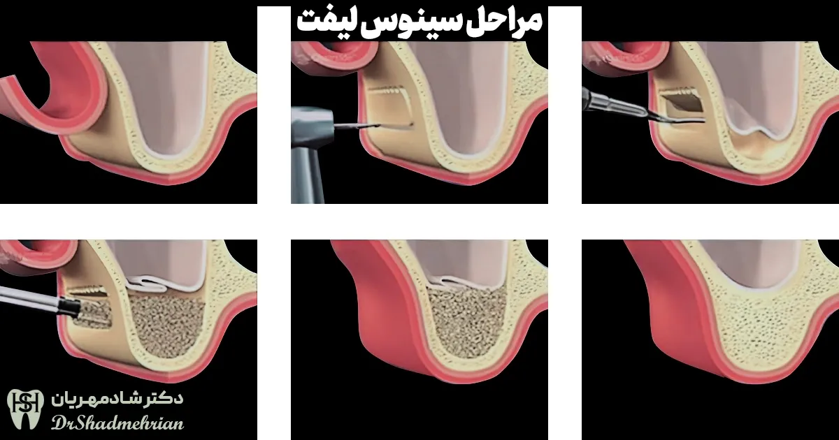مراحل سینوس لیفت