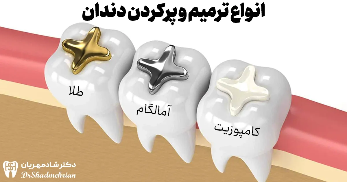 انواع ترمیم دندان و پر کردن دندان با کامپوزیت و آمالگام و طلا