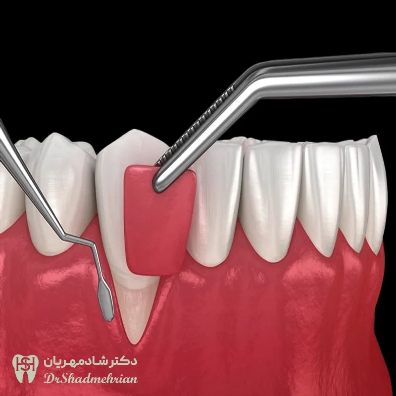 جراحی لثه
